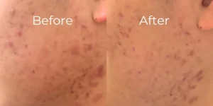 ニキビ肌改善のビフォーアフター