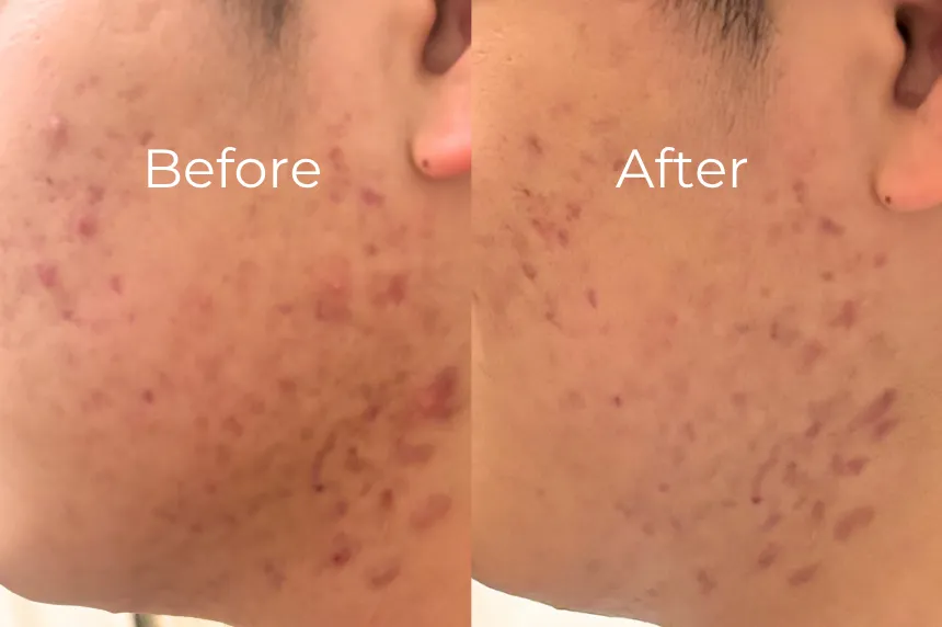 ニキビ肌改善のビフォーアフター